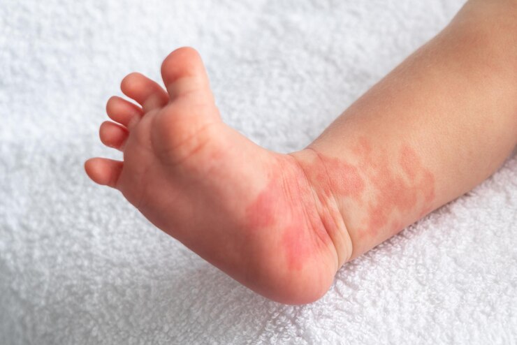 Foto hemangioma marca de nascimento vermelha na perna de um recém-nascido