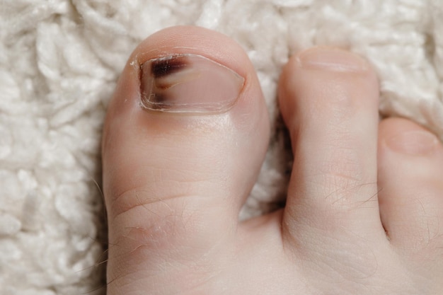 Hematoma subungueal presente debajo de la uña del dedo gordo del pie, más comúnmente conocido como dedo gordo del pie