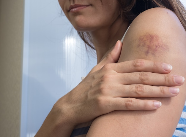 Foto hematomas na mão de uma mulher com cabelo escuro em uma camiseta listrada de branco-azul