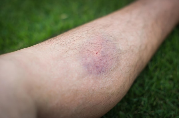 Foto hematomas na pele da perna