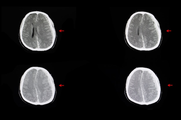 Hemorragia intracraniana e edema cerebral