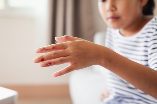 Herida fresca y sangre de heridas en los dedos de un niño después de un accidente.