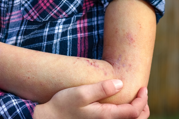 Foto a heridas dermatitis atópica en manos de un niño.