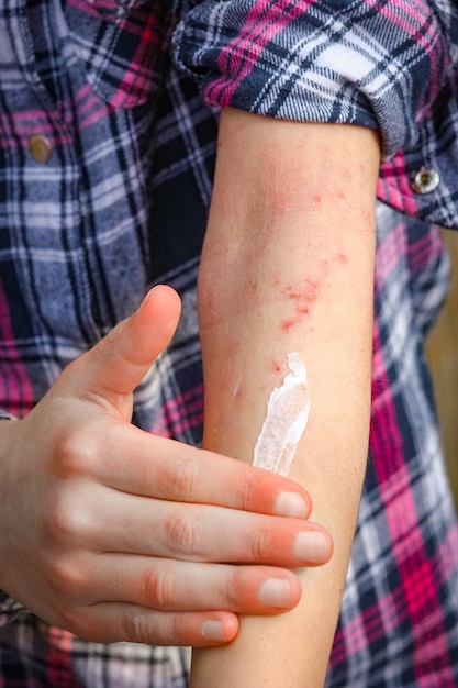 A heridas dermatitis atópica en manos de un niño.