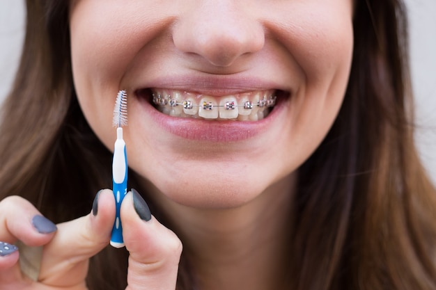 Hermosa joven con brackets metálicos para dientes con cepillo y dientes blancos