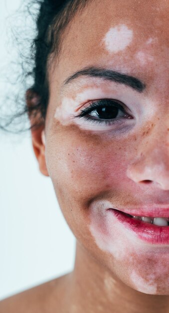 Hermosa mujer con piel de vitiligo posando en estudio. Concepto de positividad corporal y autoaceptación