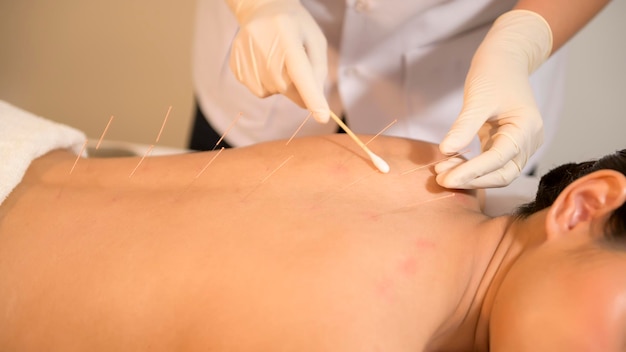 Hermosa mujer recibió tratamiento de acupuntura en la espalda por parte de un terapeuta de medicina china