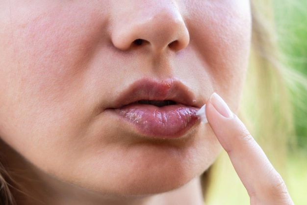 Herpes auf den Lippen der jungen Frau Nahaufnahme