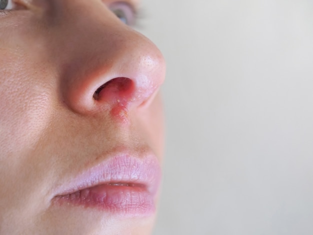 Foto herpes debaixo do nariz