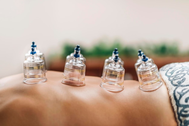 Hijama-Schröpfbehandlung auf dem Rücken von Frauen