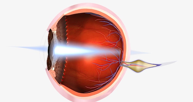 La hipermetropía es una condición visual común en la que la capacidad del ojo para enfocar objetos cercanos se ve afectada.