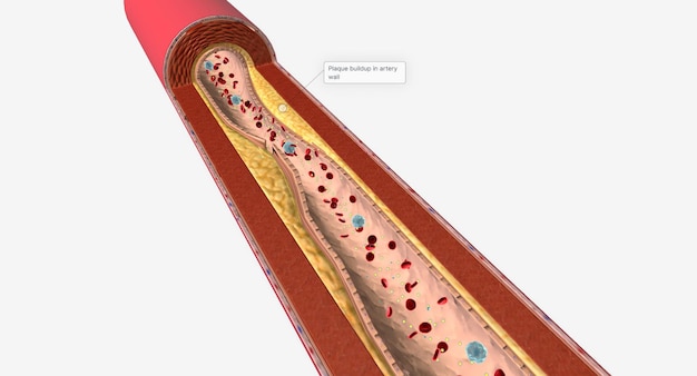 La hipertrigliceridemia es una condición común caracterizada por un alto