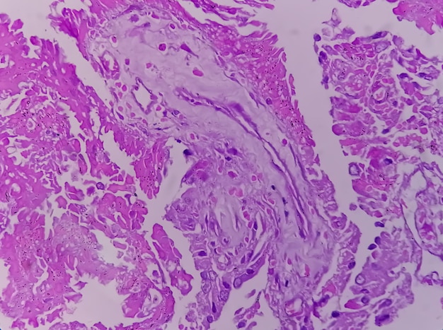 Histología del adenocarcinoma papilar metastásico