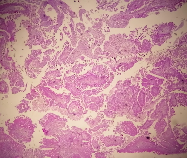 Histologia do adenocarcinoma papilar metastático