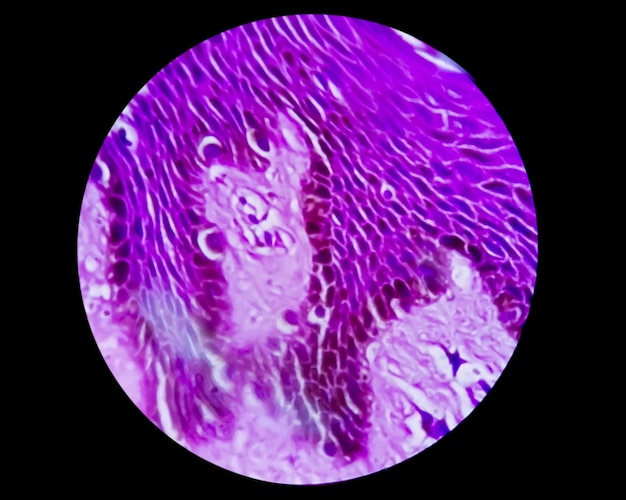 Histologische Biopsie der Skrotalwand unter dem Mikroskop, die Calcinosis cutis zeigt. Skrotalkalzinose.