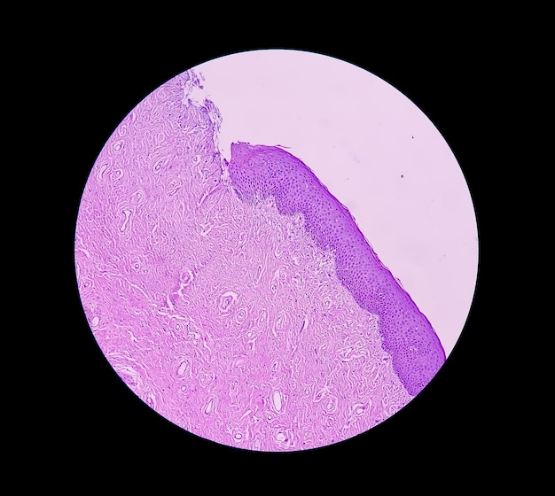 Histologische Untersuchung einer Uterusbiopsie, die auf einen Uterusprolaps hindeutet. Chronischer Zervixprolaps.