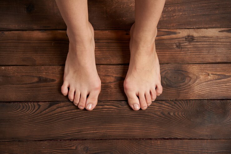 Hllux Valgus en piernas femeninas de cerca sobre fondo de madera