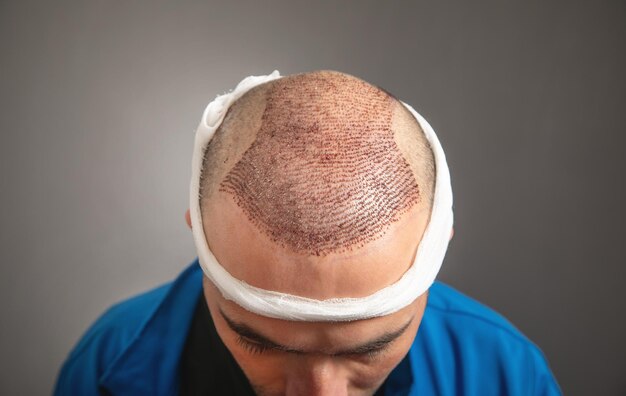 Foto hombre caucásico después de un trasplante de cabello