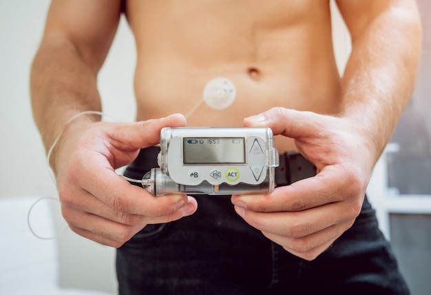 Hombre diabético con una bomba de insulina conectada en su abdomen.