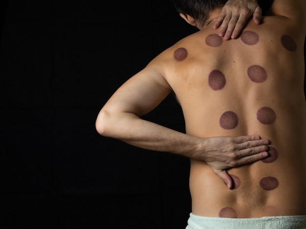 Foto hombre con dolor de espalda. medicina tradicional. rastros de procesamiento con latas en la parte posterior