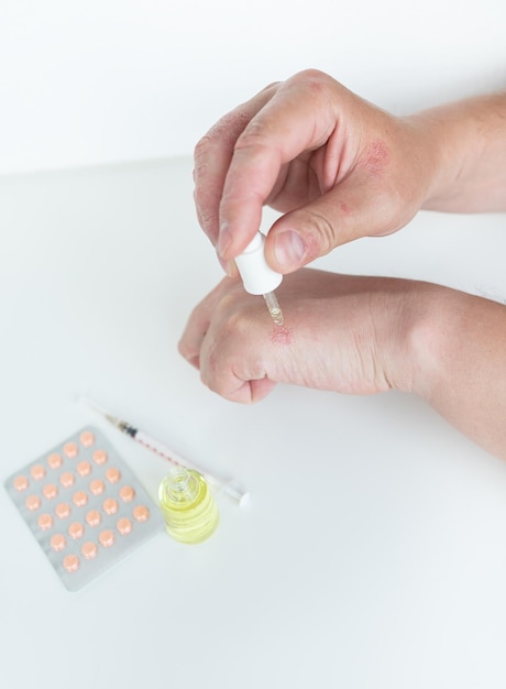 Un hombre se esparce gel curativo en las manos. Las causas de la picazón en la piel pueden ser dermatitis, eccema, piel seca, quemaduras, alergias alimentarias, concepto de atención médica.