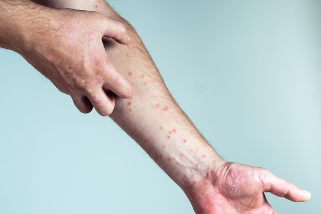 Hombre irreconocible que sufre de psoriasis rascando racimos gruesos erupción escamosa en la piel del brazo con los dedos afectados