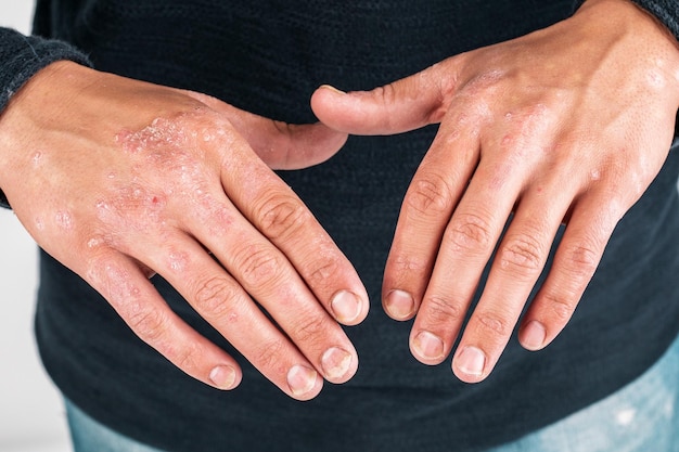 El hombre con las manos enfermas seca la piel escamosa en la mano con psoriasis vulgar, eccema y otras enfermedades de la piel, como erupciones en placas de hongos y manchas Enfermedad genética autoinmune