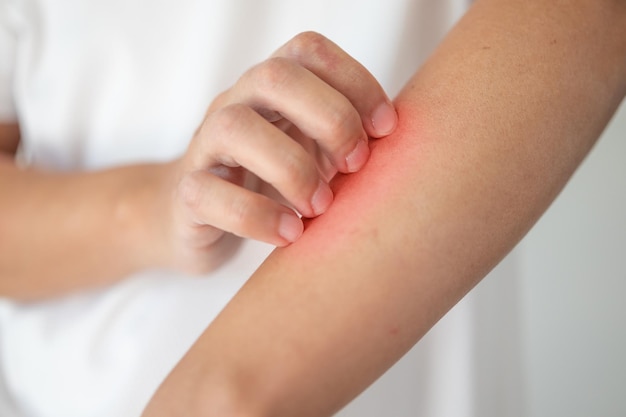 Hombre picazón y rascarse en el brazo debido a picazón en la piel seca eczema dermatitis