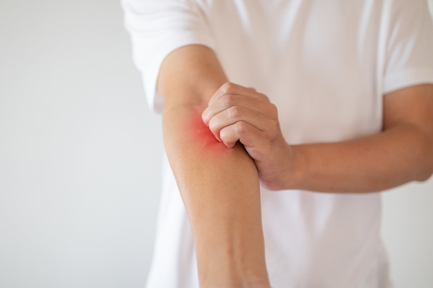 Foto hombre picazón y rascarse en el brazo por picazón en piel seca dermatitis por eccema