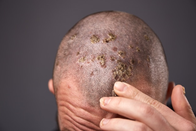 Hombre con piel seca y escamosa en la cabeza con psoriasis y hongos en las uñas de las manos. Enfermedad genética autoinmune.