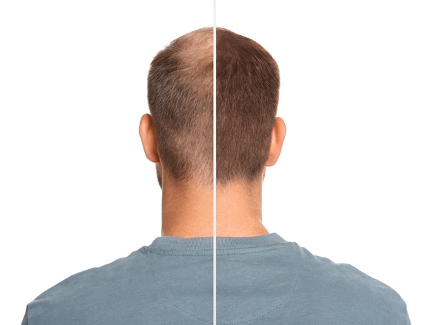 Foto hombre con problema de pérdida de cabello antes y después del tratamiento en collage de fondo blanco tricólogo visitante