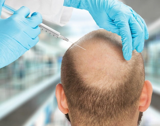 Foto hombre que pierde cabello con una inyección, tratamiento capilar