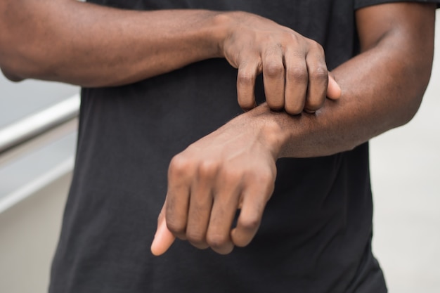 Hombre que sufre de picazón en la piel; hombre africano enfermo rascándose la piel con alergia, sarpullido, tiña, problema de tiña; cuidado de la salud, cuidado de la piel, concepto de dermatología; hombre africano adulto, modelo de hombre negro