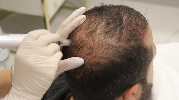 Foto un hombre sometido a terapia capilar.