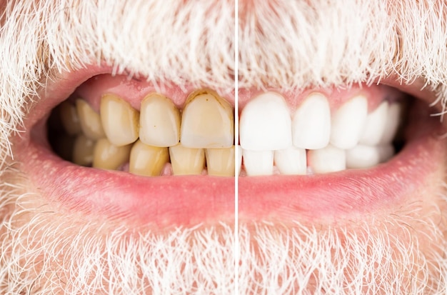 Foto hombre sonriente antes y después del procedimiento de blanqueamiento dental primer plano primer plano de un hombre sonriente dientes antes y después del blanqueamiento dientes masculinos antes y después del blanqueamiento cuidado bucal odontología estomatología
