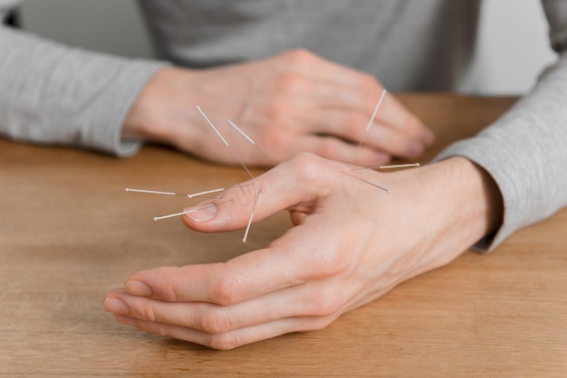 Hombre usando tratamiento de acupuntura para aliviar el dolor