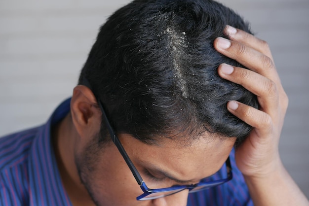 Hombres con caspa en su primer cabello