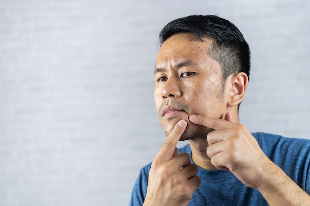 Homem apontando acne inflamada ocorre em seu rosto.