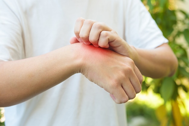 Homem coçando e coçando a mão devido a erupção cutânea alérgica causada por picada de inseto ao ar livre