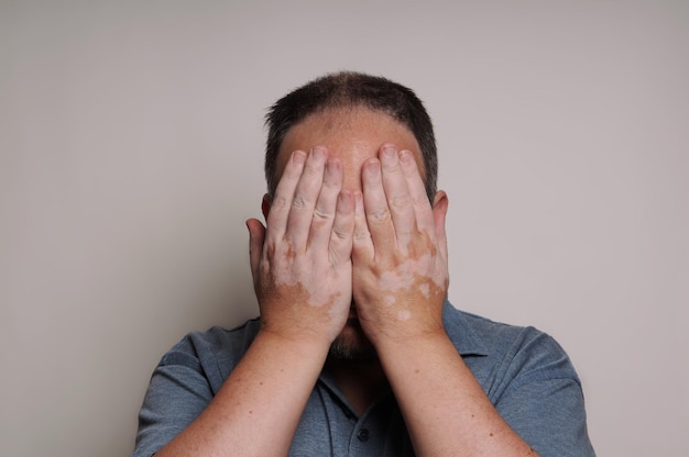 Homem com Vitiligo escondendo o rosto