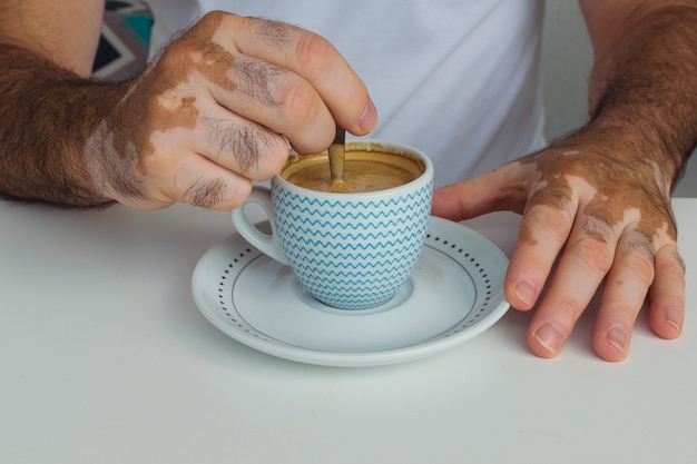 Homem com vitiligo segurando uma xícara de café