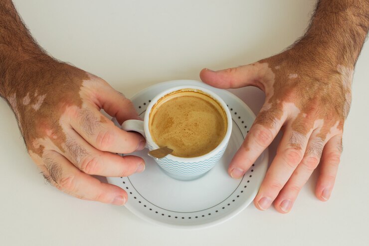 Homem com vitiligo segurando uma xícara de café