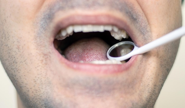 homem no dentista visita espelho bucal verificando dentes dente