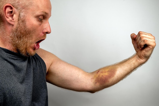 Foto homem olhando no grande hematoma no braço humano