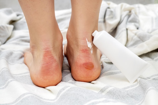 Hornhaut und Hühneraugen, Frauenfuß, Füße, Folge des Tragens unbequemer Schuhe, dermatologische Erkrankungen