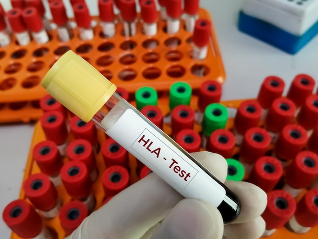 Humanes Leukozyten-Antigen oder HLA-Test