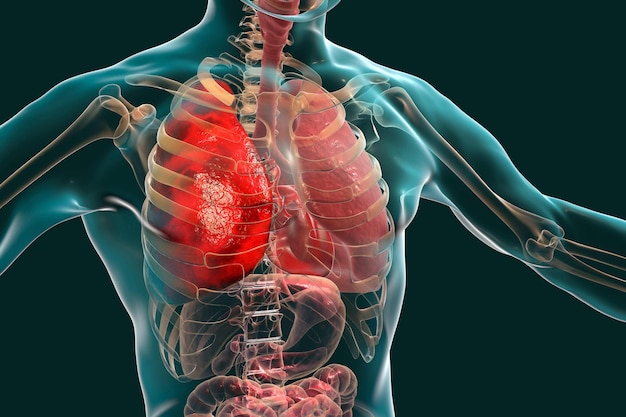 Ilustração 3D do conceito médico de pneumonia mostrando pneumonia lobar do pulmão direito