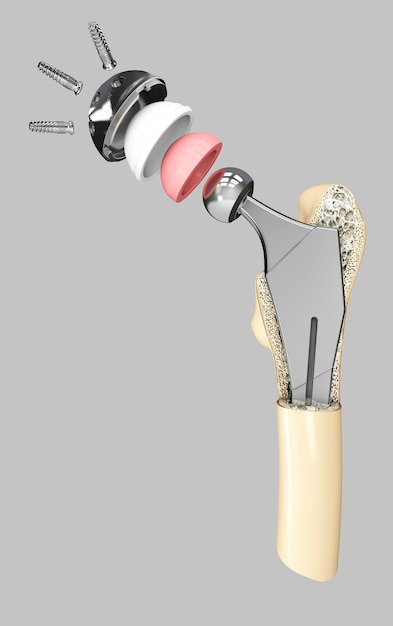 Foto ilustración 3d estructura de implante de cadera gris aislado.
