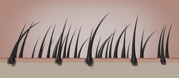 Ilustración 3D de folículos pilosos secos y dañados