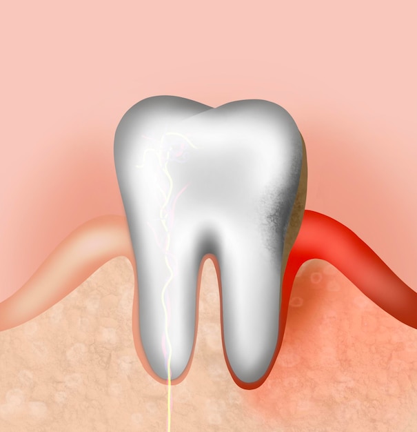 Ilustración de dientes y encías infectadas Enfermedad periodontal